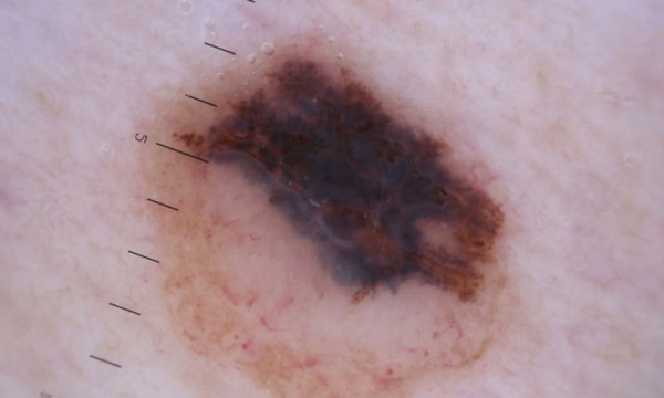 melanoma