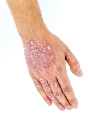 pikkelysomor-psoriasis